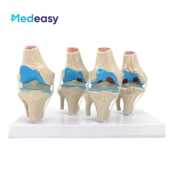 Модел на колянната става при остеоартрит 4 етапа на човек Патологична Модел на колянната става